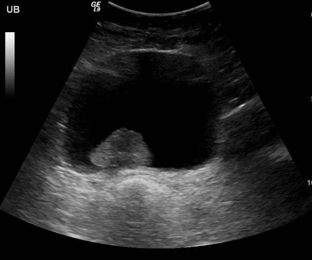 Bladder cancer seen on ultrasound.