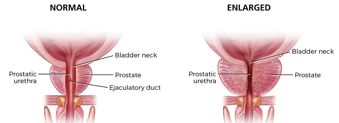 An enlarged prostate can obstruct the flow of urine.