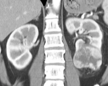 Kidney cancer shown on a coronal CT scan.