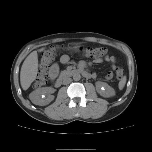Kidney stones shown on a CT scan.