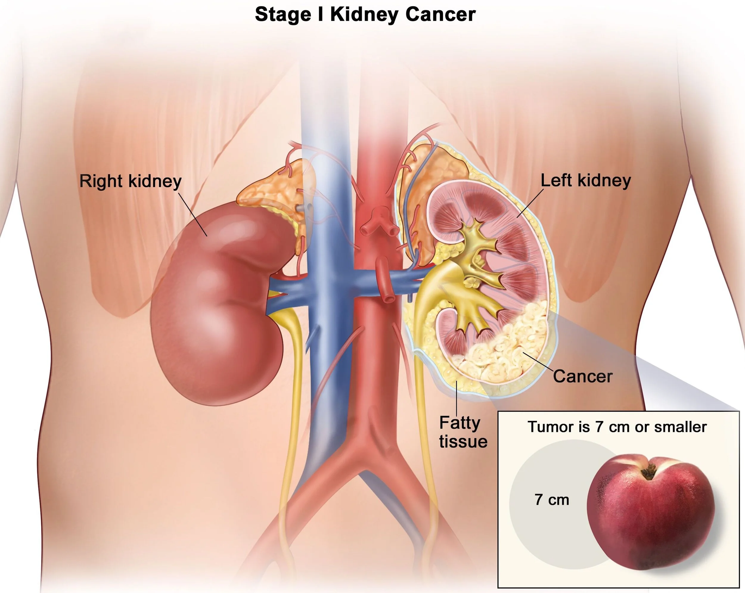 Stage 0 (non-invasive) bladder cancer.