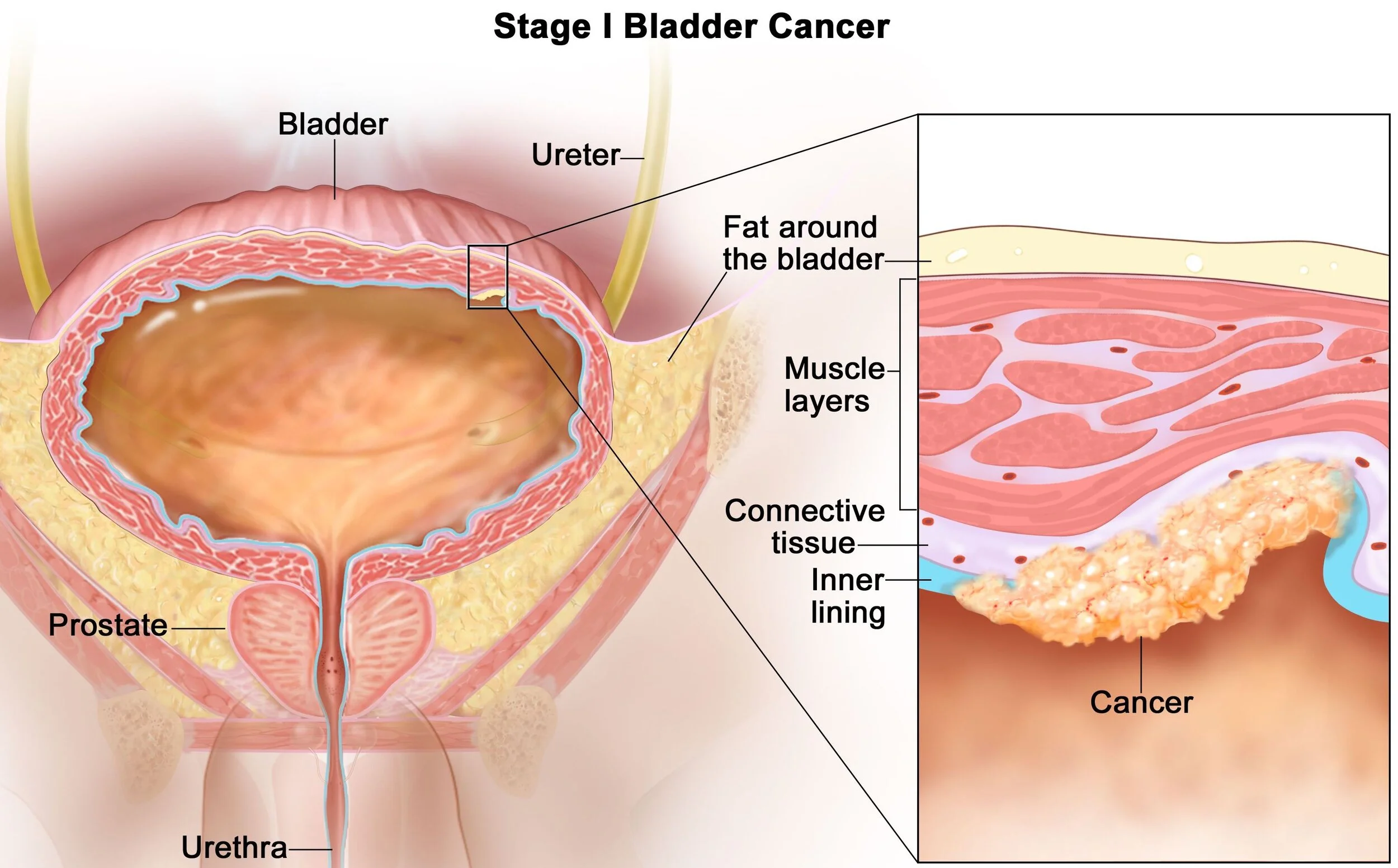 Stage 1 bladder cancer.